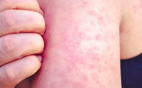 Une peau rougie et irritée, recouverte de petits boutons de chaleur, est grattée par des doigts.