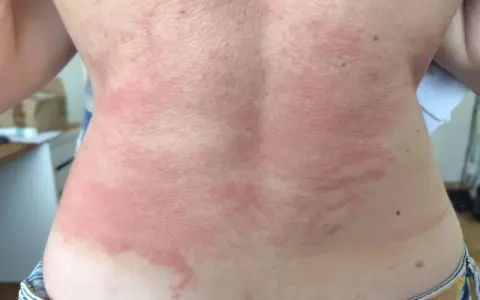 Le dos présente des plaques rouges et irritées, typiques d'un **eczéma peau**. La zone affectée est étendue, allant du cou jusqu'à la taille.