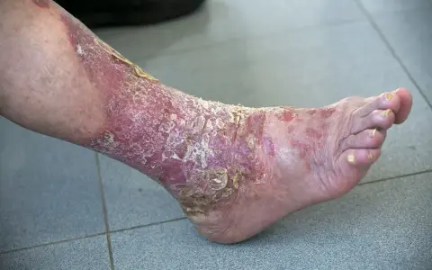 Psoriasis palmo plantaire sévère sur la jambe et le pied, avec peau rouge, squameuse et craquelée.
