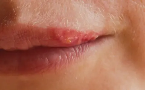 Lèvres rouges et irritées, signe d'un herpes labial que faire pour soulager ?