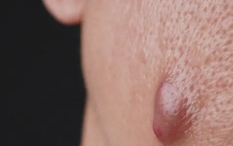 Gros plan sur une peau présentant des pores dilatés et une lésion inflammatoire typique de l'acné conglobata.