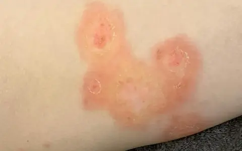 Plaques rouges et squameuses sur la peau, évoquant une mycose fessier adulte.