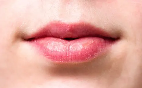 Gros plan sur des lèvres gercées qui ne guérissent pas, la peau semble sèche et craquelée.