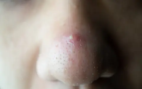 Gros plan sur un nez avec un point noir douloureux et enflammé, entouré de pores visibles.