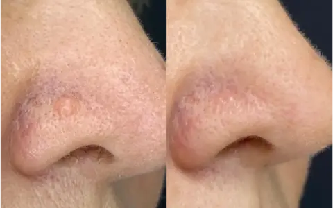 Comparaison avant/après traitement d'une papule fibreuse du nez. La lésion a disparu.