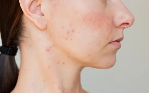 Peau du bas du visage avec des rougeurs et un bouton.