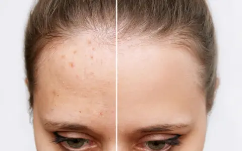 Avant/après : front avec acné et front lisse. L'acide salicylique bienfait pour une peau nette.