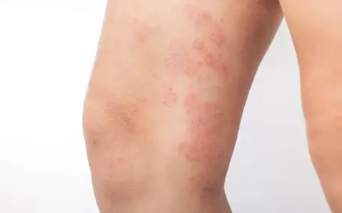 Plaques rouges et squameuses sur la jambe, caractéristiques de l'eczéma nummulaire.
