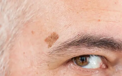 Gros plan sur un œil et un sourcil, avec une tache vieillesse brune sur le front.