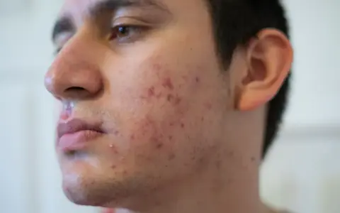Visage d'un jeune homme avec des rougeurs et des boutons, signes d'acné nodulaire.