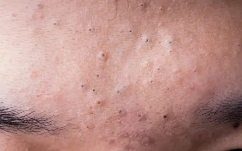 Gros plan sur la peau du front, révélant de minuscules boutons et des pores dilatés, avec des sourcils foncés en bas.