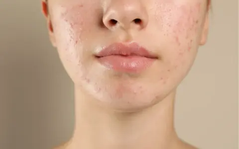 Visage d'une jeune femme avec une peau à tendance acnéique. L'acide salicylique fait ressortir les boutons, révélant une peau en cours de traitement.