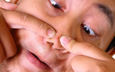 Doigts pinçant un gros bouton noir sur la peau du nez, gros plan sur le visage.
