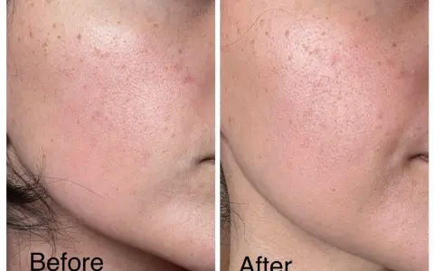 Avant/après : peau avec rougeurs et taches, avant utilisation d'acide azélaïque. Après, la peau est plus lisse, sans danger apparent.