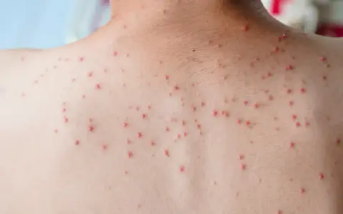 Vue rapprochée du dos d'une personne couverte de petits boutons rouges, possiblement dus à une infection virale comme la varicelle.