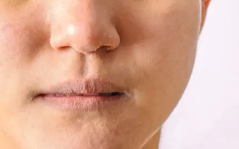 Peau sèche et squameuse autour du nez et des lèvres, signe d'un manque de sébum.
