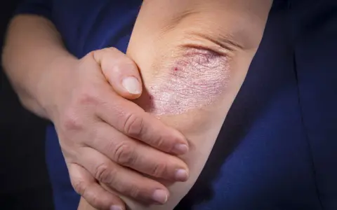 Une personne touche son coude, révélant une plaque de psoriasis inversé, rouge et squameuse, sur sa peau.