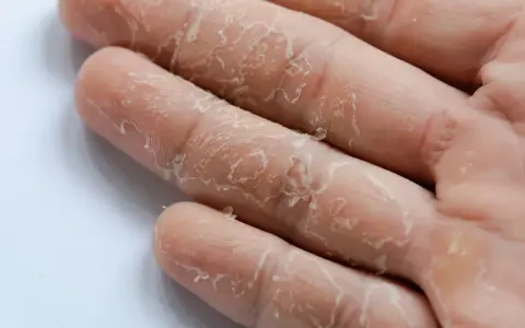 Gros plan sur des mains qui pèlent, signe visible de stress. La peau se détache en fines lamelles sur les doigts.