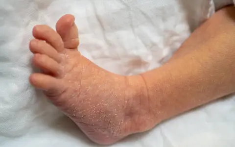 Pied de bébé avec peau sèche et squameuse, évoquant le psoriasis bébé.