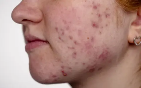 Gros plan sur le visage d'une jeune femme, montrant une peau rougie avec de nombreux comédons et boutons d'acné.