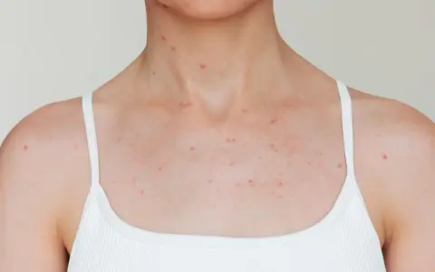 Poitrine et cou d'une personne portant un débardeur blanc, avec de nombreux petits boutons rouges visibles sur la peau.