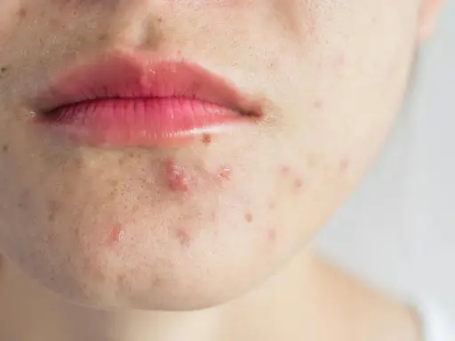 Gros plan sur le bas du visage d'une personne, montrant des imperfections et un bouton sans pu près de la bouche.