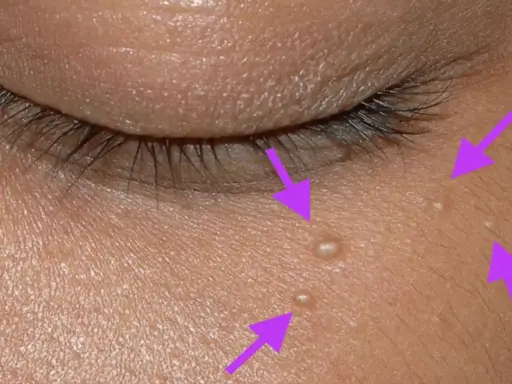 Gros plan sur la peau près de l'œil, montrant plusieurs petits points blancs, des grains de milium percer, indiqués par des flèches violettes.