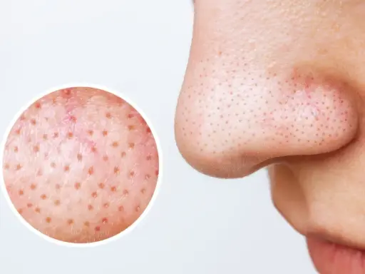 Gros plan sur le nez montrant des filaments sébacés dans les pores. Une loupe révèle la texture de la peau, suggérant des remèdes maison pour les imperfections.