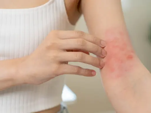 Une personne se gratte le bras, révélant un petit bouton sur les bras allergie, rouge et irrité.