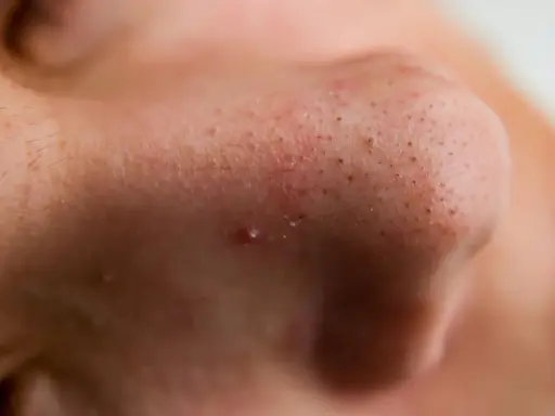 Gros plan sur un nez avec des pores visibles et un bouton avec point noir au milieu.