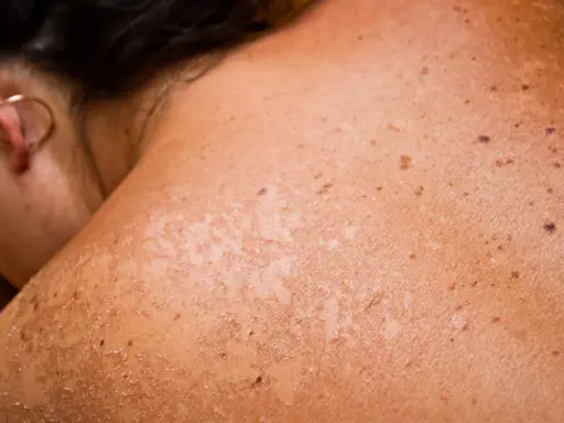 Gros plan sur une épaule et un cou montrant une peau bronzée avec des taches brunes et des zones de peau qui pèle, signe d'un coup de soleil.