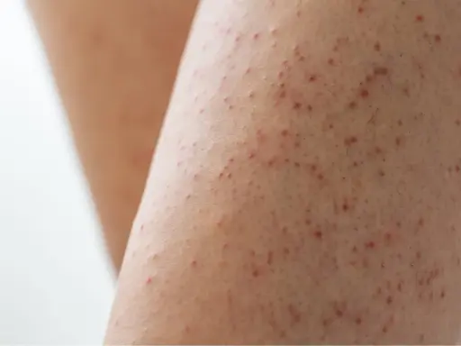 Gros plan sur une peau présentant de petites rougeurs et aspérités, signe d'un excès de kératine peau.