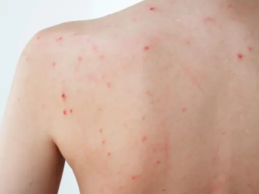 Éruption cutanée sur le dos, avec de nombreux petits points rouges, certains semblant être un bouton inflammatoire douloureux.