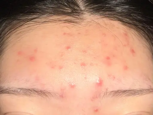Plusieurs petits boutons rouges parsèment le front, sous la ligne des cheveux.