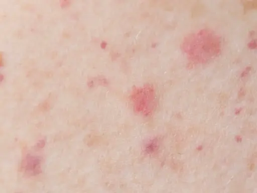 Gros plan sur une peau présentant des pétéchies et des signes de vieillissement cutané, avec des taches rouges et des irrégularités de texture.