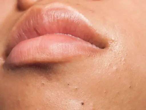 Gros plan sur des lèvres roses et une peau présentant plusieurs points noirs, ces petites imperfections qui peuvent apparaître sur le visage.