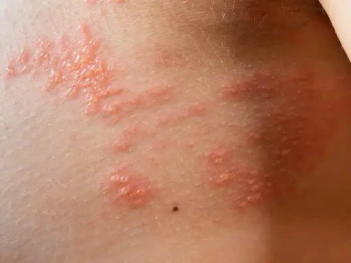 Peau irritée avec un petit bouton cloque qui gratte, formant des grappes rouges et enflammées.