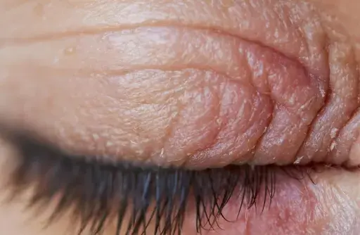 Gros plan sur un œil fermé, montrant des paupières sèches et irritées avec des ridules et des squames.