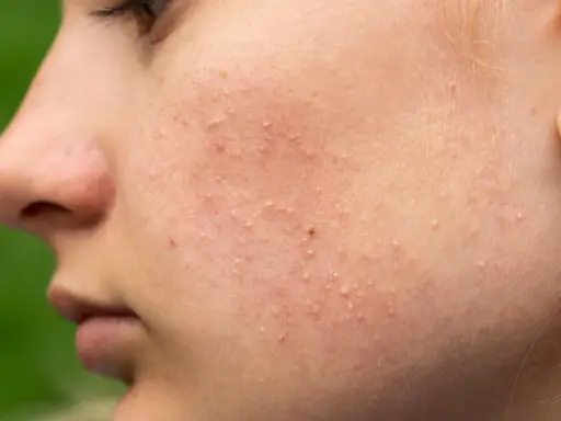 Gros plan sur la joue d'une personne avec de nombreux petits boutons, un bouton de stress qui gratte, et quelques rougeurs.