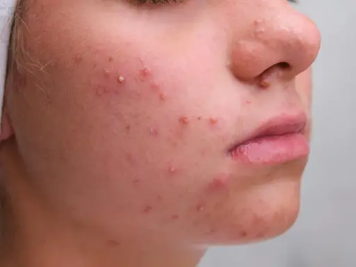 Gros plan sur un visage avec de nombreux boutons blancs et rouges, signe d'une peau à problèmes.