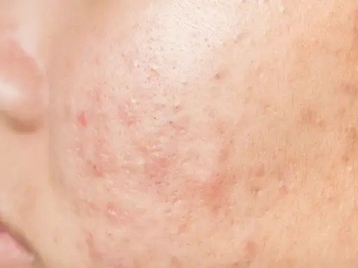 Gros plan sur la peau d'un adulte présentant des rougeurs et des marques, typiques d'un bouton visage adulte.