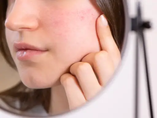 Gros plan sur un visage reflété dans un miroir, montrant une rougeur diffuse et des petits points rouges, signe d'un érythrose du visage.