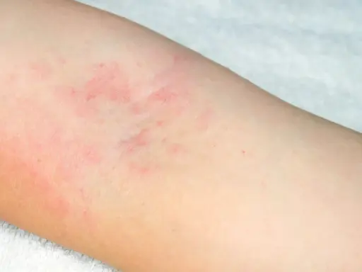 Début d'eczéma sur le bras, avec des plaques rouges et irritées sur la peau claire.