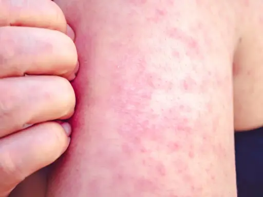 Une peau rougie et irritée, recouverte de petits boutons de chaleur, est grattée par des doigts.