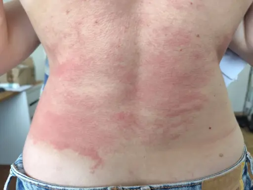Le dos présente des plaques rouges et irritées, typiques d'un **eczéma peau**. La zone affectée est étendue, allant du cou jusqu'à la taille.