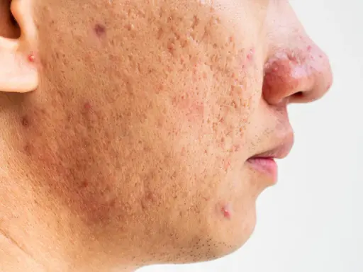 Gros plan sur le visage d'une personne montrant des cicatrices et des rougeurs dues à une acné sévère.