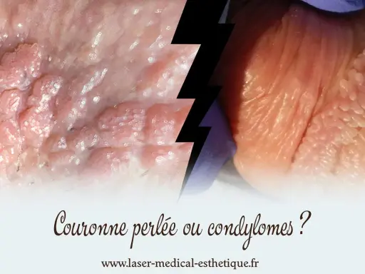 Gros plan sur des papules perlées et des condylomes, deux affections cutanées distinctes.