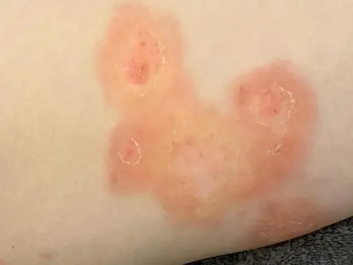 Plaques rouges et squameuses sur la peau, évoquant une mycose fessier adulte.