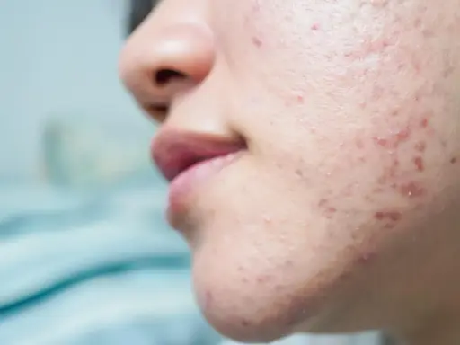 Gros plan sur une peau acnéique, montrant des rougeurs et des imperfections. Ce type d'acné peut être lié à l'effet de la progestérone sur la peau.