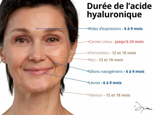 Visage d'une femme avec des lignes indiquant la durée des traitements à l'acide hyaluronique. Attention, l'acide hyaluronique n'assèche pas la peau, il la repulpe.